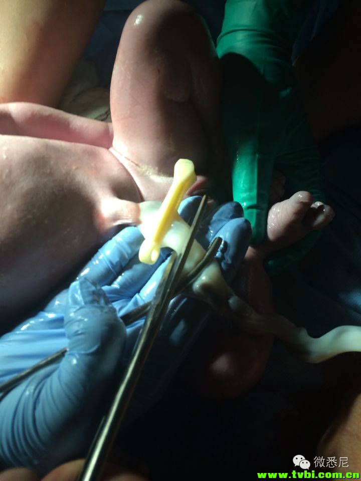 剖腹产全程拍摄，看完后震惊了！附澳洲生产经验(请转给需要的人) ...