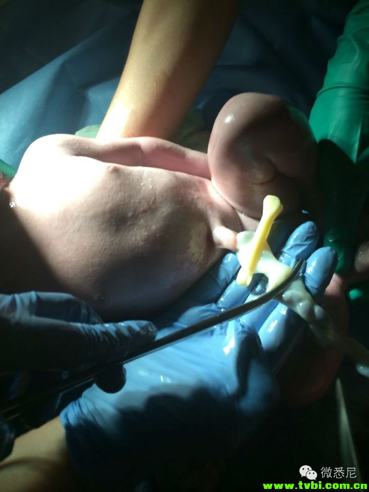 剖腹产全程拍摄，看完后震惊了！附澳洲生产经验(请转给需要的人) ...